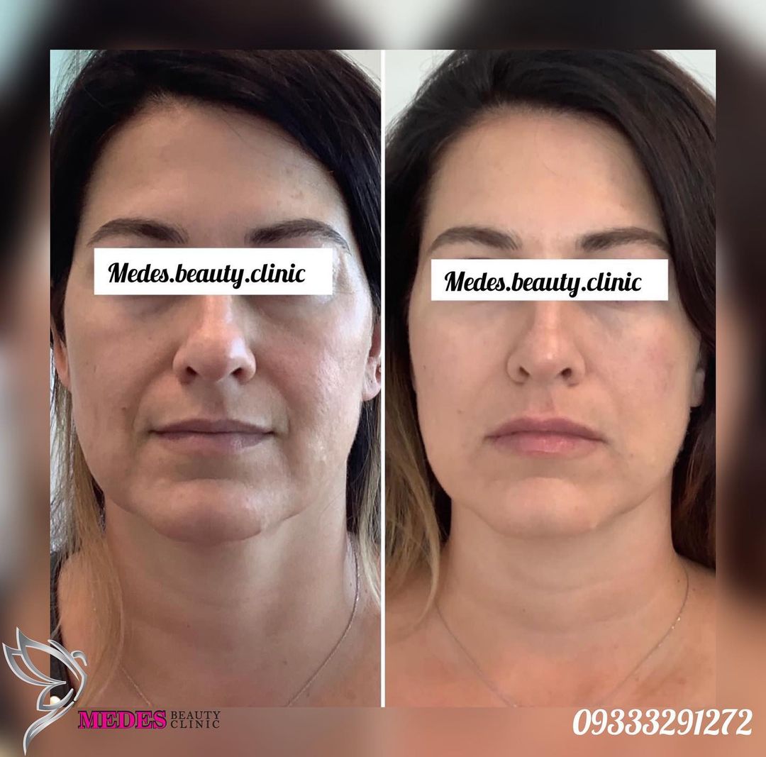 گالری هایفوتراپی